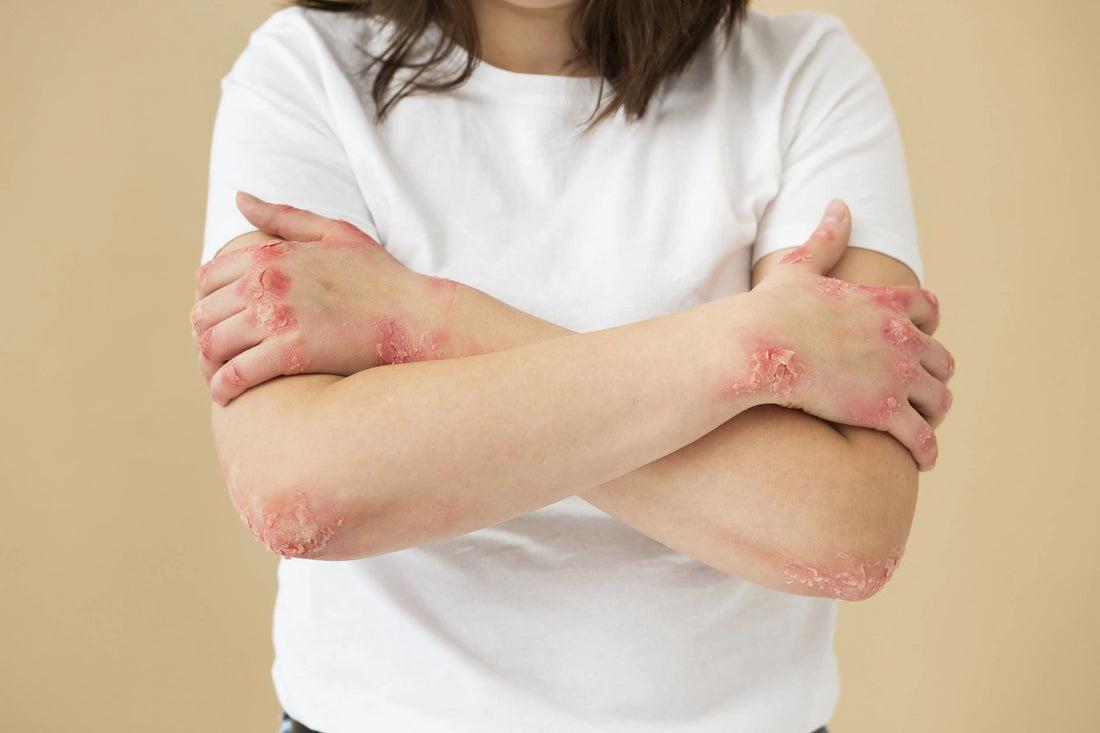 Differentiating Hives and Rashes: Identifying Key Distinctions - Nibasu