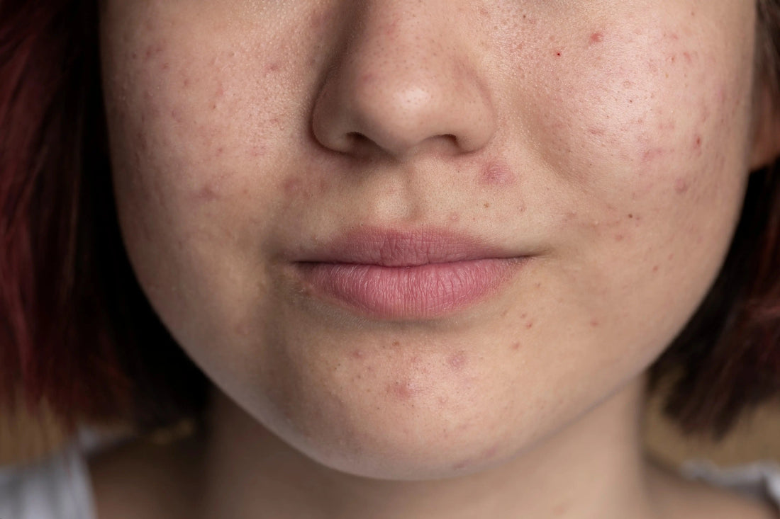 Does Eating Eggs Cause Pimples? What Science Says About Eggs and Acne - Nibasu