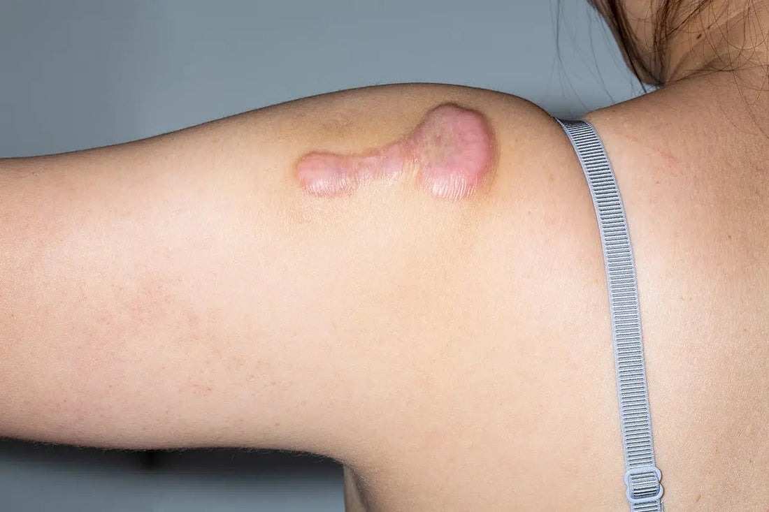 Keloids vs. Piercing Bumps: Understanding the Differences - Nibasu