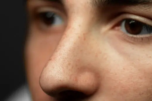 Understanding Blackheads on the Nose - Nibasu