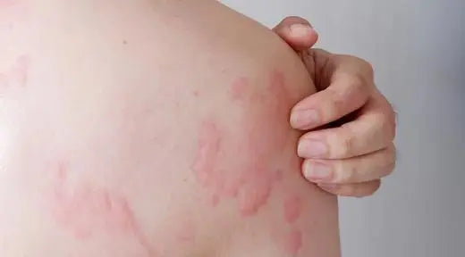 Understanding Welts: Causes, Symptoms and Treatments - Nibasu